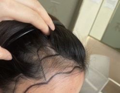 -碧莲盛·不剃发植发