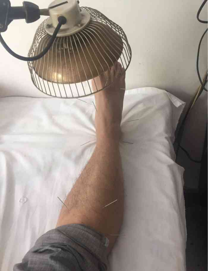 打分 脚扭伤,一个月没好,出差成都过来扎了一次,就感觉有所改善,后来