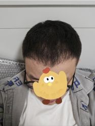 -大麦微针植发丨全国连锁