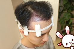 -大麦微针植发丨全国连锁