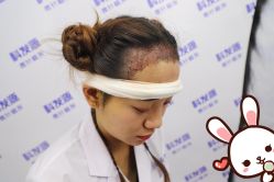 -大麦微针植发丨全国连锁