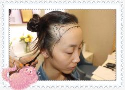 点击看大图 -大麦微针植发全国连锁