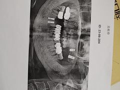 -上海仁爱医院口腔科 · 种植