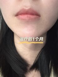 体验后-郑荃丽格医疗美容
