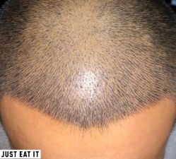 -大麦微针植发丨全国连锁