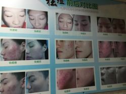点击看大图 -苗方清颜专业祛痘连锁机构