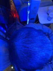 -碧莲盛·不剃发植发