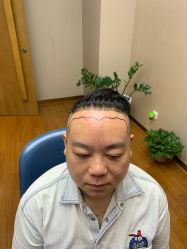 -大麦微针植发全国连锁