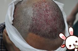 -大麦微针植发丨全国连锁