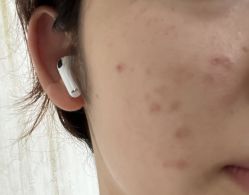 体验后-新雨池不针清祛痘