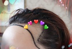 -大麦微针植发全国连锁