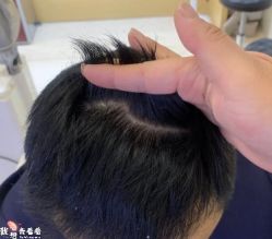 -大麦微针植发丨全国连锁