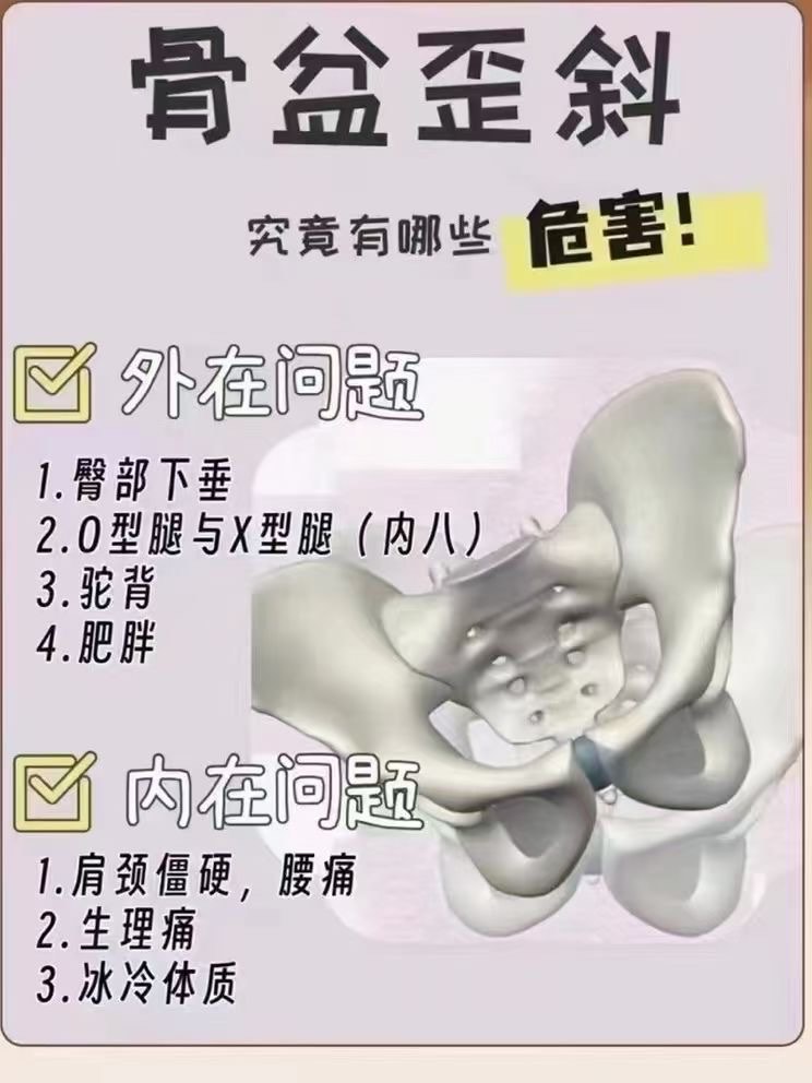 骨盆后倾的危害图片