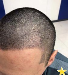 -大麦微针植发丨全国连锁