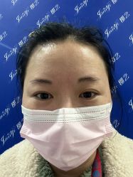 体验前-郡艺医疗美容·微整·眼鼻吸脂