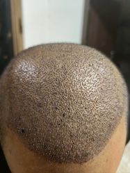 -碧莲盛·不剃发植发