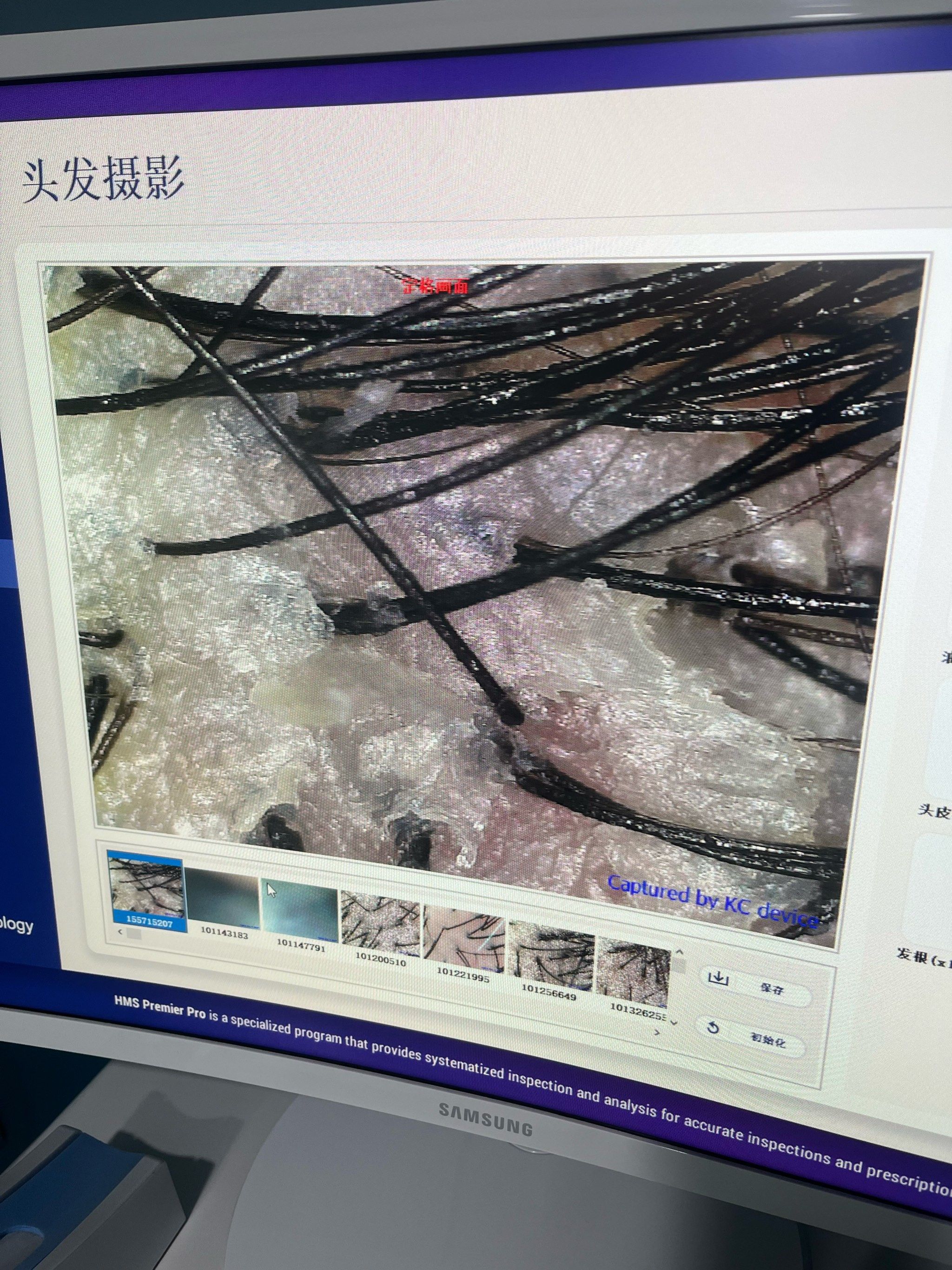 为什么头皮会有头皮屑?百科在线