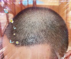 -大麦微针植发全国连锁