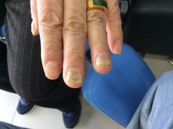 -德哥灰指甲脚气甲沟炎跖疣护理