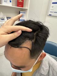 体验前-大麦微针植发全国连锁