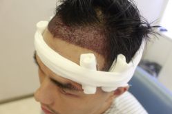 -大麦微针植发丨全国连锁