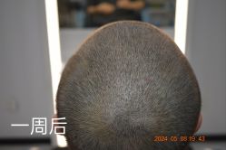 体验后-大麦微针植发全国连锁