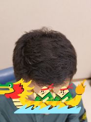 体验后-大麦微针植发丨全国连锁