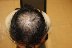 -大麦微针植发丨全国连锁