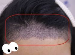 -大麦微针植发全国连锁