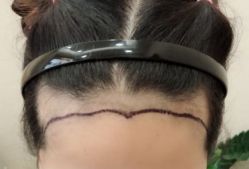 -大麦微针植发丨全国连锁