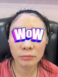 体验后-深圳春天阳光医院·轮廓抗衰中心