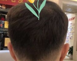 点击看大图 -大麦微针植发全国连锁