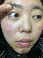 -北京美痣堂古方祛痣斑疣瘊