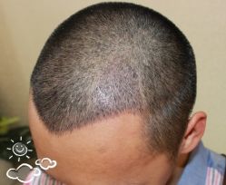 -大麦微针植发丨全国连锁