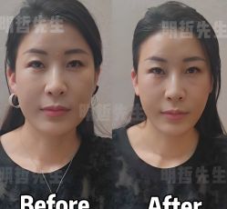 -颜和骨正&明星徒手小颜整骨