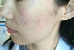 -爱莎扁平疣·汗管瘤·斑痣中心