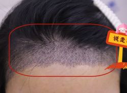 -大麦微针植发全国连锁