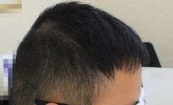 -大麦微针植发全国连锁