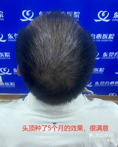 头发少去植发中心养发(头发少去植发中心养发有效果吗)