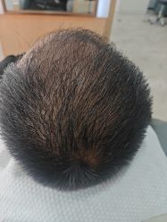 -大麦微针植发丨全国连锁