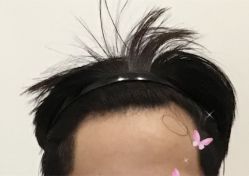 -大麦微针植发全国连锁