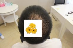 -大麦微针植发丨全国连锁