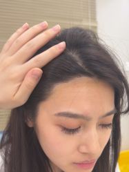 -大麦微针植发丨全国连锁