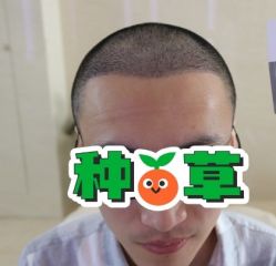 -大麦微针植发丨全国连锁