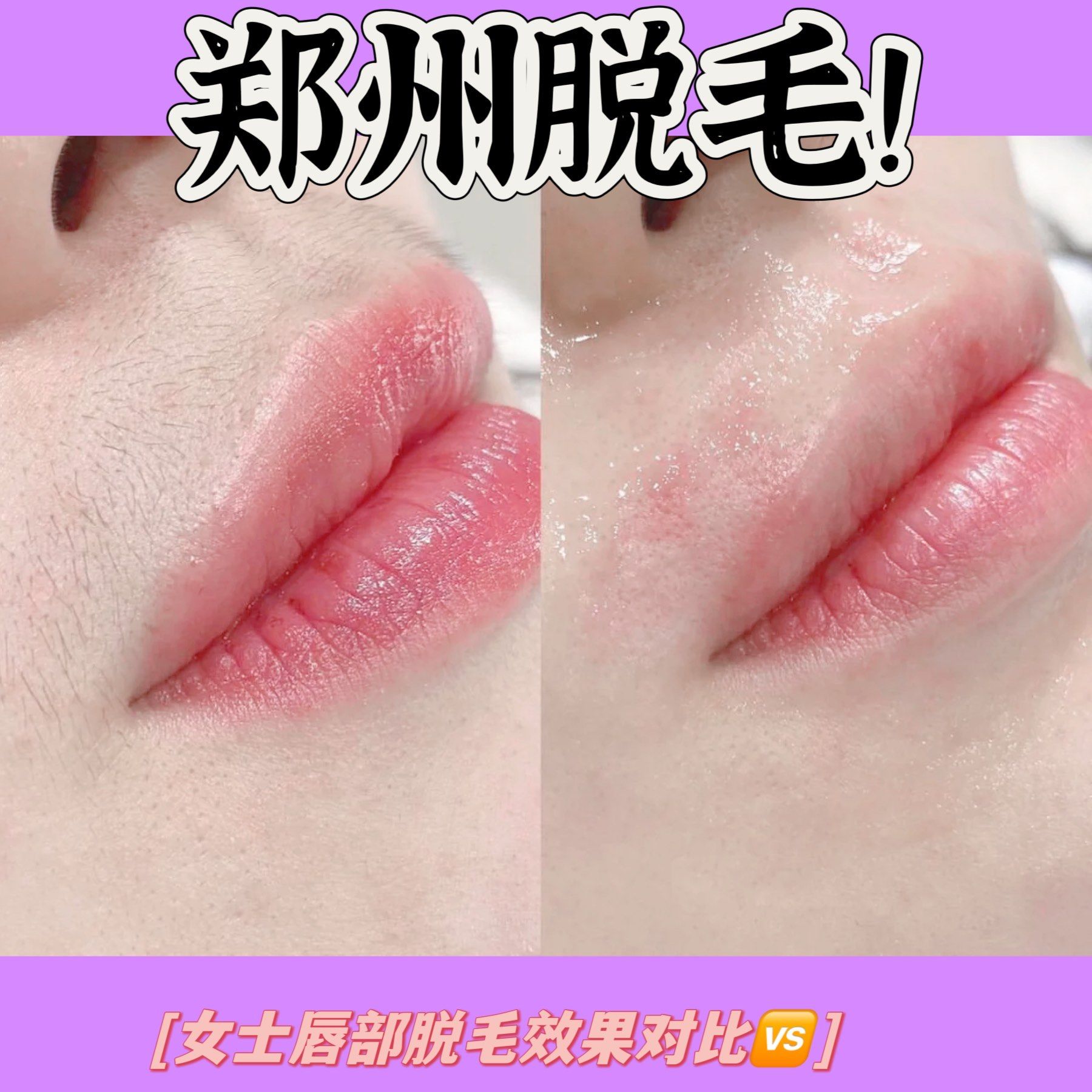 女士唇部脱毛效果对比90超干净[礼花][礼花][礼花]