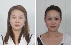 开眼角 双眼皮对比照片-西美医疗美容门诊部