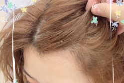 -大麦微针植发全国连锁