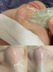 -苗方清颜专业祛痘连锁机构