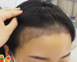 -大麦微针植发丨全国连锁