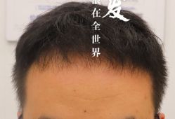 -大麦微针植发全国连锁